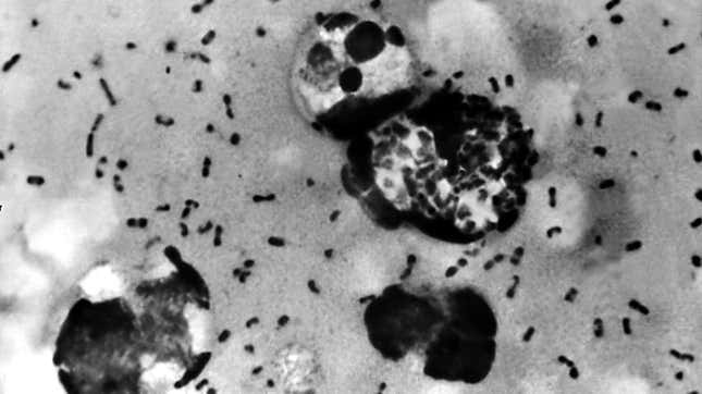 A bubonic plague smear, prepared from a lymph removed from an adenopathic lymph node, or bubo, of a plague patient, demonstrates the presence of the Yersinia pestis bacteria that causes the plague in this undated photo.
