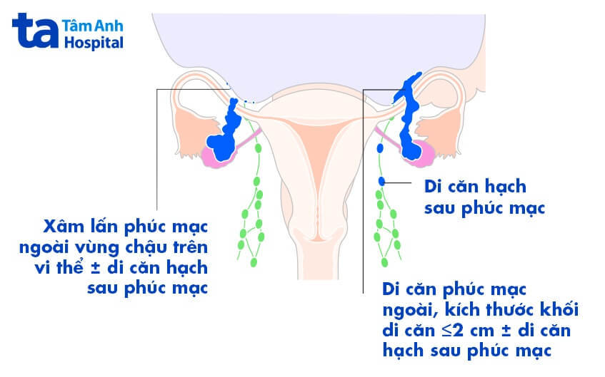 ung thư buồng trứng giai đoạn 3 đã di căn